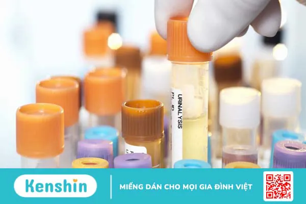 Xét nghiệm protein niệu 24 giờ là gì? Có tác dụng gì? 1