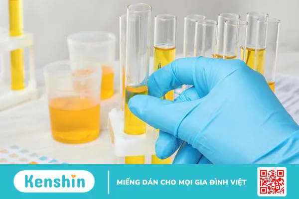 Xét nghiệm protein niệu 24 giờ là gì? Có tác dụng gì? 5