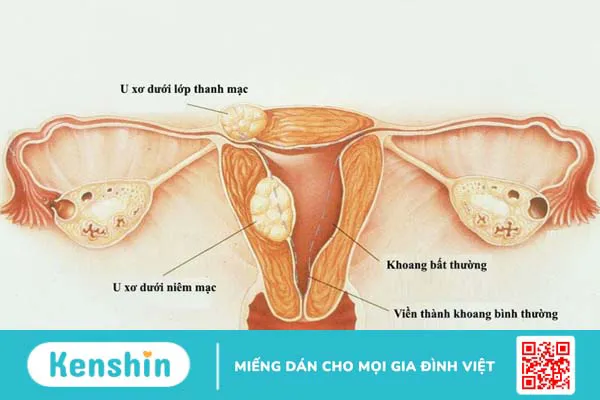 Xét nghiệm u xơ tử cung: Tầm quan trọng và cách đề phòng bệnh 1