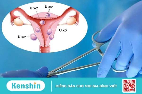 Xét nghiệm u xơ tử cung: Tầm quan trọng và cách đề phòng bệnh 3