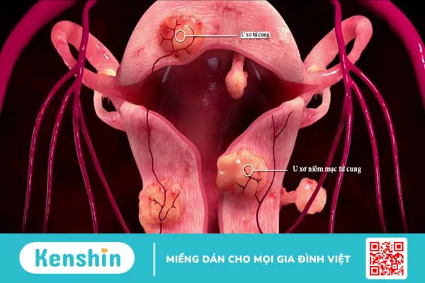 Xét nghiệm u xơ tử cung: Tầm quan trọng và cách đề phòng bệnh 2