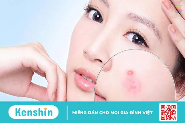 Xóa tan nỗi lo về mụn mủ với Derma Angel 1