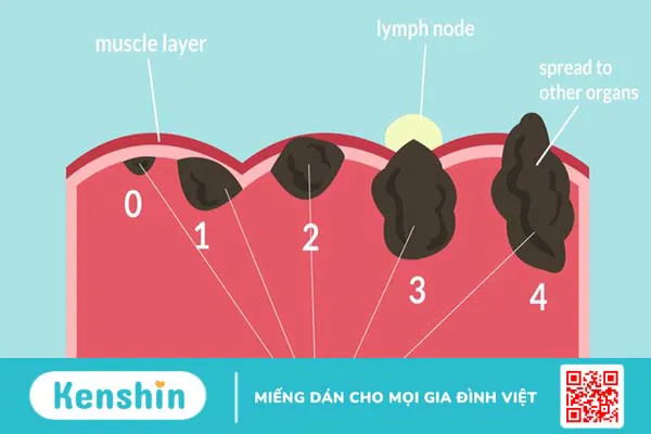 Ý nghĩa xác định giai đoạn của bệnh ung thư 4