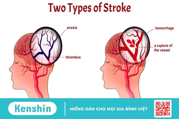 Yếu tố nào gây ra hiện tượng đột quỵ sau tập thể thao? Cách xử trí và phòng tránh 1