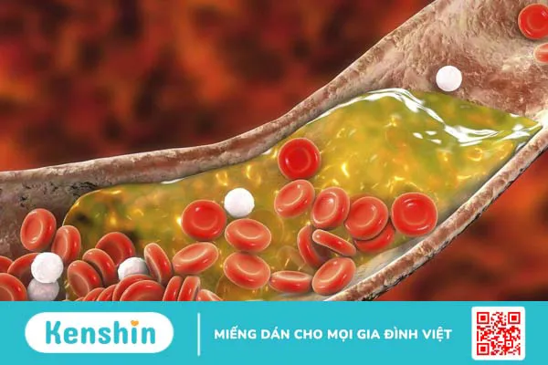 5 cách giúp bạn giảm cholesterol và phòng ngừa đột quỵ1