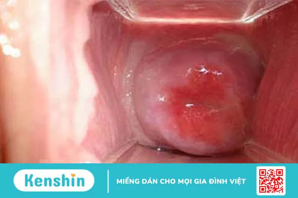 5 Nguyên nhân dẫn đến thâm vùng kín và cách cải thiện 2