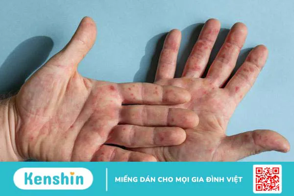 6 cách phòng bệnh tay chân miệng hiệu quả dành cho trẻ3