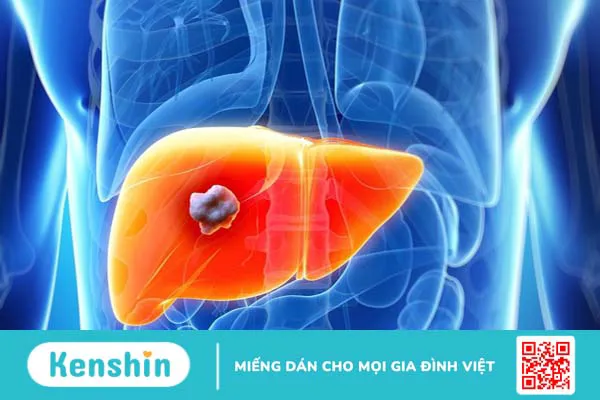 Áp xe gan nhiễm khuẩn: Nguyên nhân, triệu chứng, chẩn đoán và cách điều trị 1