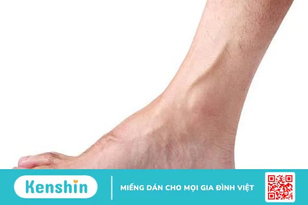 Bàn chân lõm sâu là gì? Nhận biết bàn chân lõm sâu 2