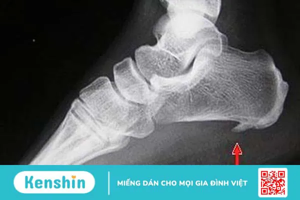 Bệnh gai gót chân là gì? Cách điều trị dứt điểm bệnh gai gót chân 1