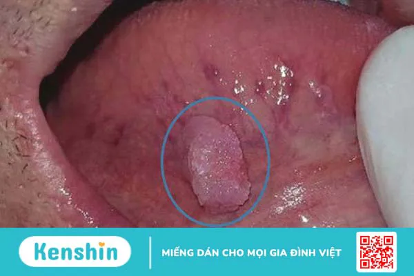 Bệnh sùi mào gà có tự khỏi không? 1