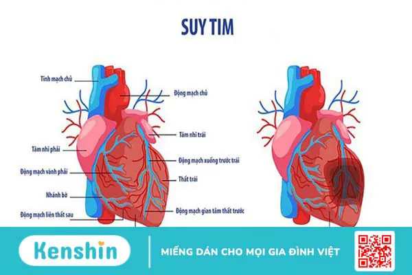 Bệnh suy tim là gì? Bệnh suy tim có chữa được không? 2