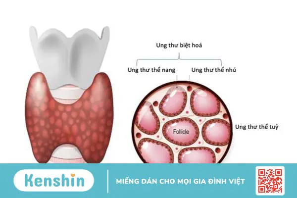 Bệnh ung thư tuyến giáp sống được bao lâu? Các yếu tố ảnh hưởng đến tuổi thọ người bệnh 1