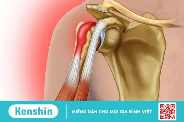 Bệnh viêm gân mạn tính: Nguyên nhân, triệu chứng và cách điều trị 1