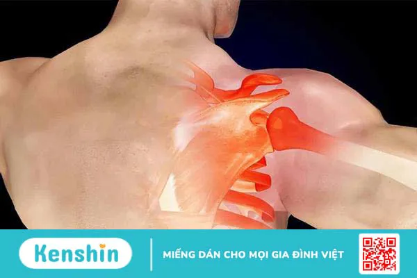 Bệnh viêm gân mạn tính: Nguyên nhân, triệu chứng và cách điều trị 2