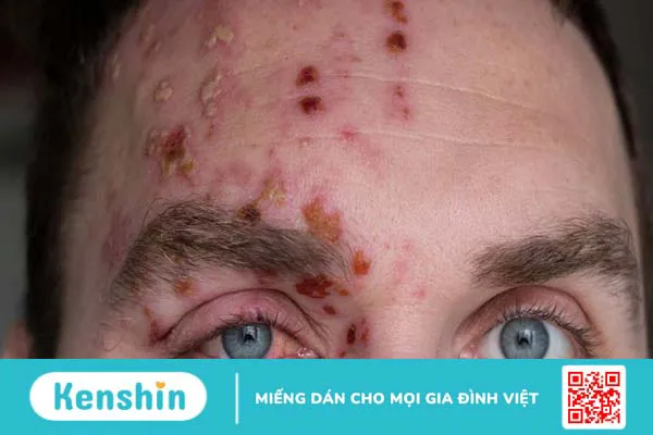 Bệnh zona thần kinh ở mặt và những điều cần biết 1