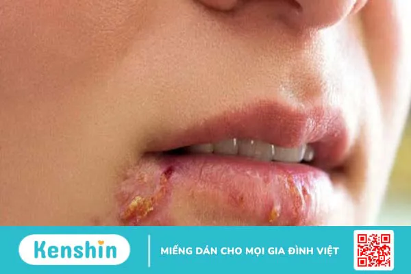 Bệnh zona thần kinh ở mặt và những điều cần biết 2