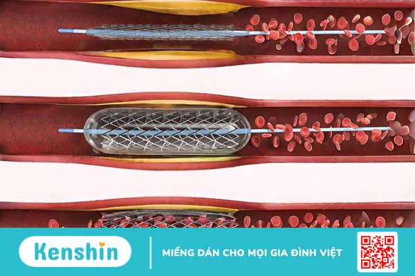 cac-loai-stent-mach-vanh-duoc-su-dung-hien-nay-gom-nhung-loai-nao 1