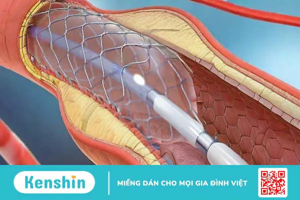 cac-loai-stent-mach-vanh-duoc-su-dung-hien-nay-gom-nhung-loai-nao 3