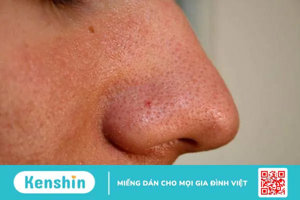 Cách trị mụn cám ở mũi tận gốc, đơn giản, bạn đã biết chưa?