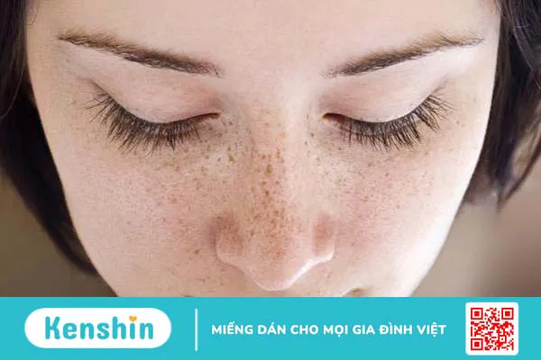 Cách trị tàn nhang tận gốc 1