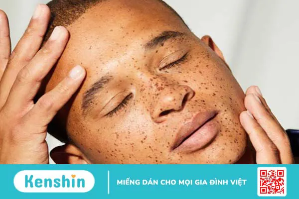 Cách trị tàn nhang tận gốc 2