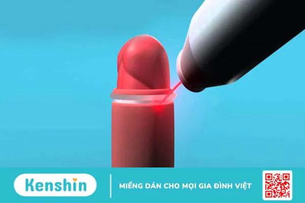 Cắt bao quy đầu bằng laser có an toàn không? Quy trình như thế nào? 3