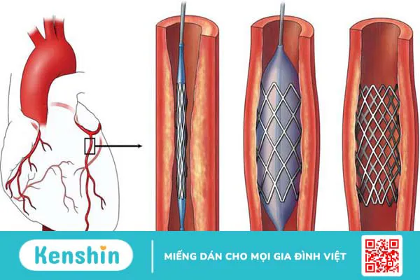 Chi phí đặt stent mạch vành có mắc không? 2