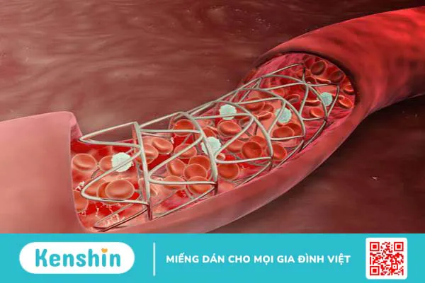 Chi phí đặt stent mạch vành có mắc không? 3