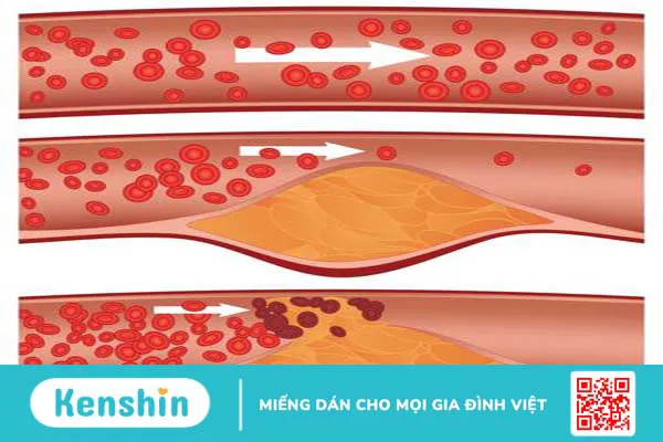 Chi phí đặt stent mạch vành có mắc không? 4