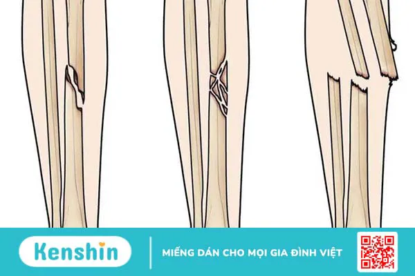 Chi phí phẫu thuật gãy xương cẳng chân có tốn kém không 1