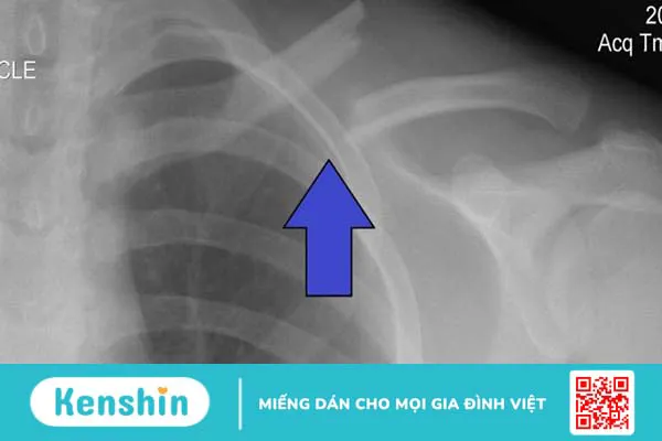 Chi phí phẫu thuật gãy xương đòn có tốn kém không 1