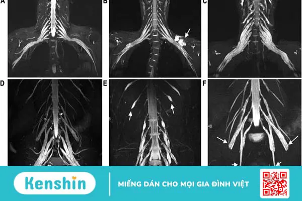 Chụp cộng hưởng từ dây thần kinh phát hiện những bệnh lý nguy hiểm nào? 2