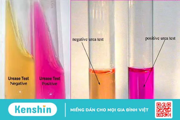 Clo test: Phương pháp chẩn đoán nhiễm vi khuẩn HP 4