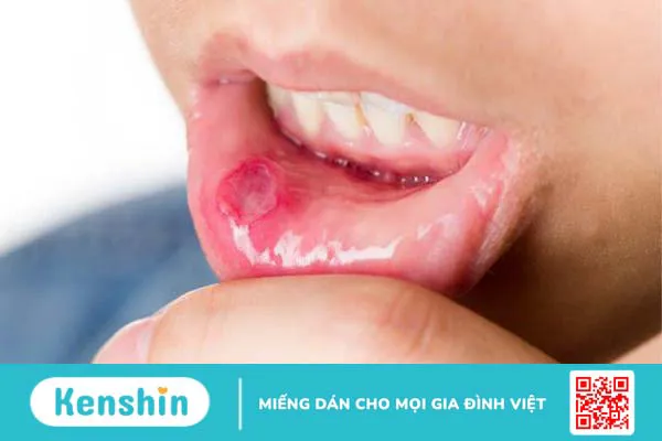 Góc giải đáp: Daktarin Oral Gel có trị nhiệt miệng không? 1