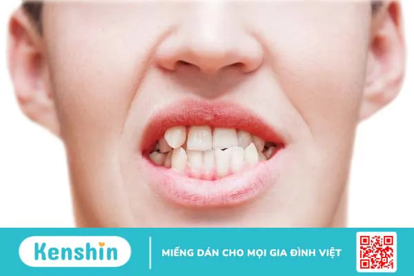 Đánh giá răng khểnh đẹp hay xấu? Nên nhổ hay niềng răng khểnh? 2