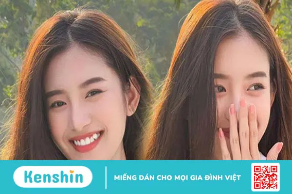 Đánh giá răng khểnh đẹp hay xấu? Nên nhổ hay niềng răng khểnh? 1