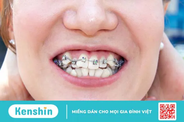 Đánh giá răng khểnh đẹp hay xấu? Nên nhổ hay niềng răng khểnh? 3