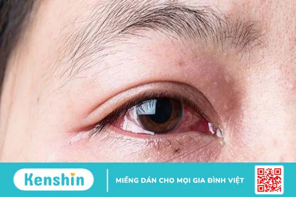 Đau mắt đỏ có ăn được tôm không? Những thực phẩm cần kiêng kị 1