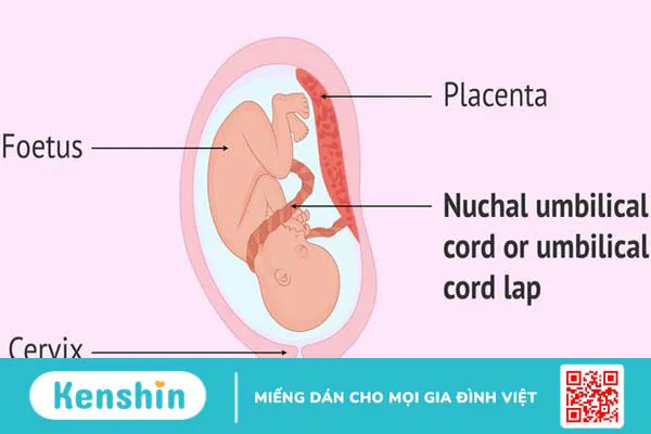 Dây rốn quấn cổ 1 vòng tuần 36 là gì? Có nguy hiểm không? 1