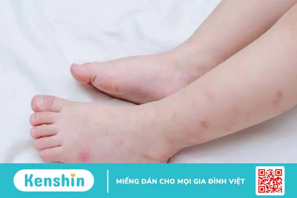 Điểm danh 7 dòng thuốc trị thâm ghẻ ở chân hiệu quả được bác sĩ khuyên dùng nhất 1