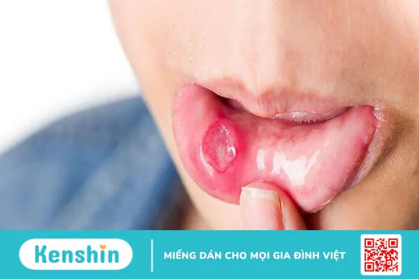 Điều trị nhiệt miệng tái phát thường xuyên như thế nào?