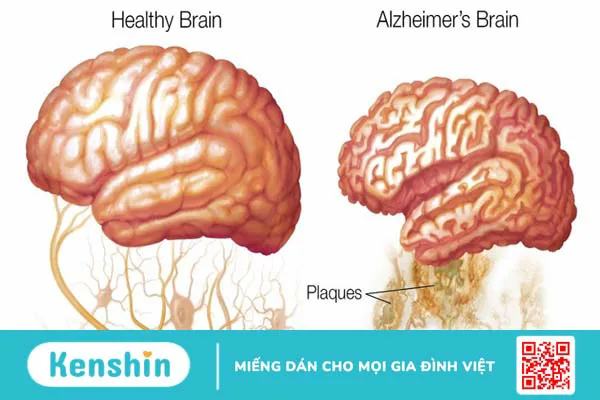 Đường làm trầm trọng thêm bệnh Alzheimer: Bạn có biết? 2