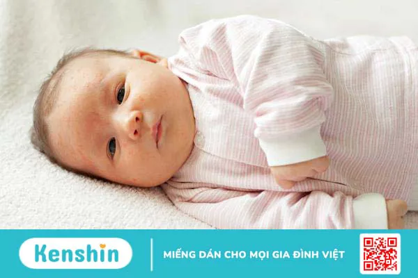 Em bé có vết lõm gần hậu môn là bệnh gì?