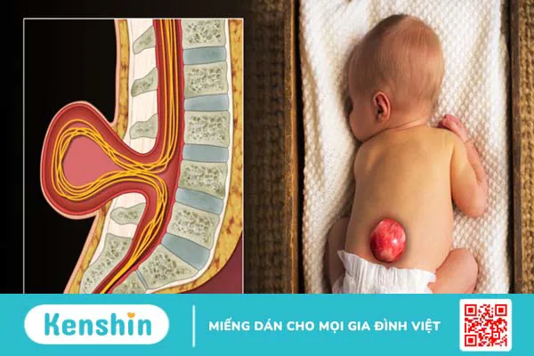 Em bé có vết lõm gần hậu môn là bệnh gì?