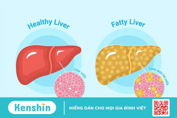 gan nhiễm mỡ độ 2 có nguy hiểm không