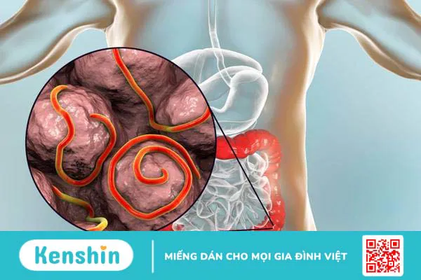 Giun kim ký sinh ở đâu? Cách nhận biết và phòng ngừa hiệu quả 2