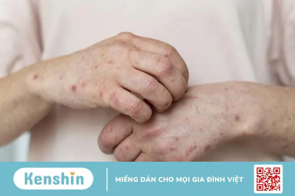 Góc giải đáp: Xét nghiệm máu nổi mề đay là gì?