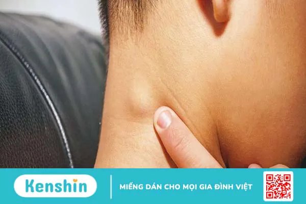 hạch hoại tử vùng cổ và những đều cần biết