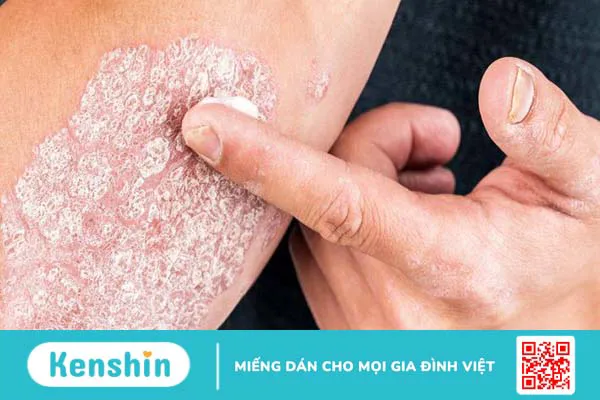 Hội chứng viêm ở bệnh vẩy nến: Mối nguy hiểm khó lường 2